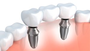 5 falsos mitos sobre los implantes dentales