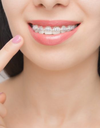 Gomas para brackets en ortodoncia ¿Qué son?