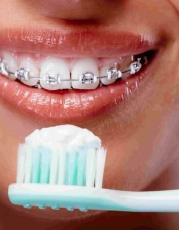 ¿Cómo limpiar los dientes con Brackets?