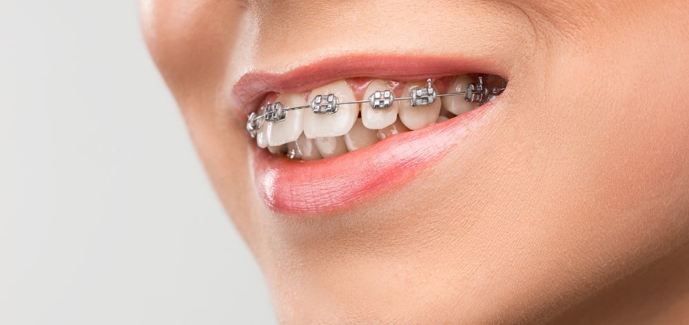 limpieza dental brackets