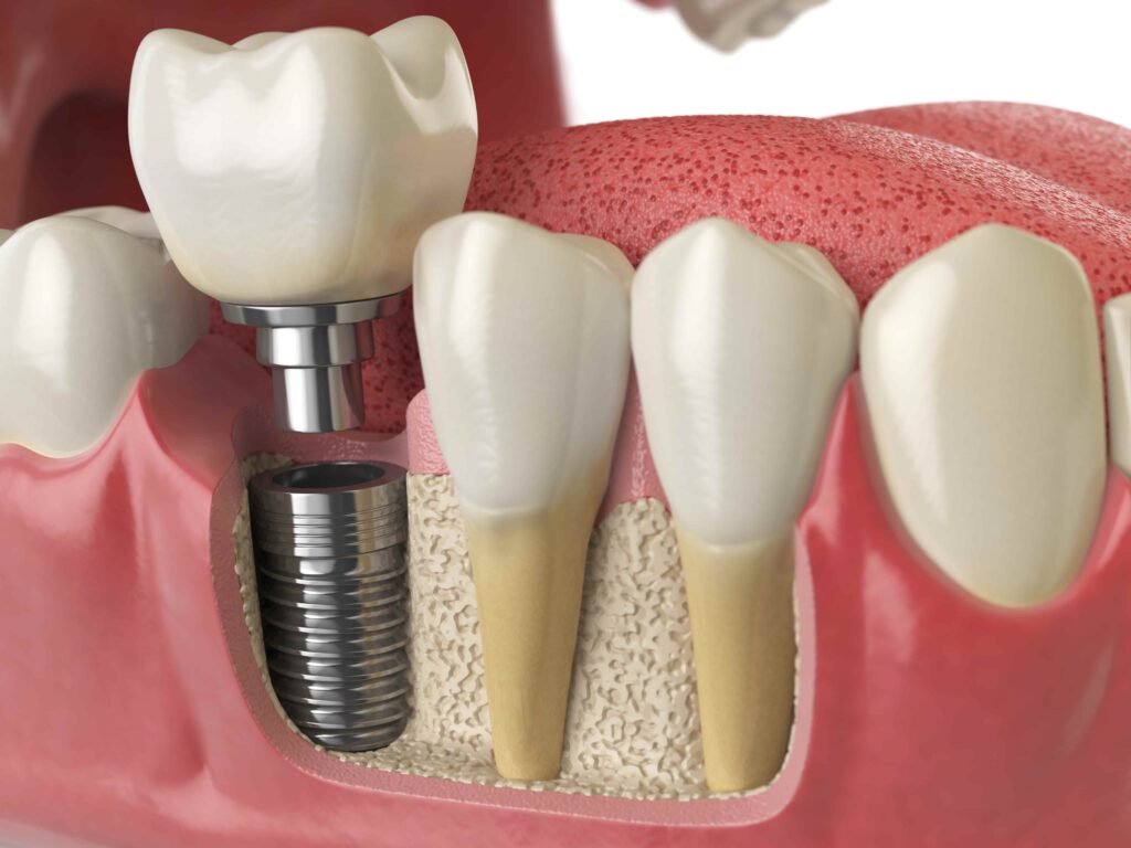 Periimplantitis en implantes dentales: ¿cómo evitarla?
