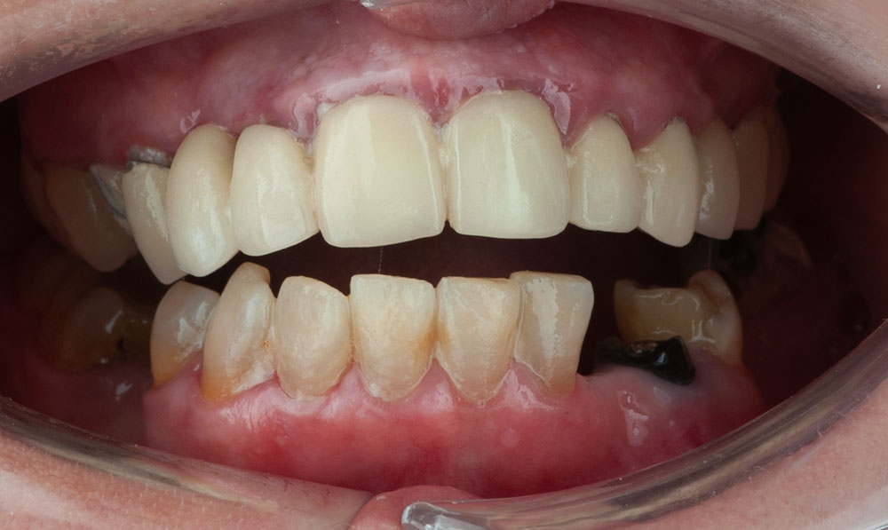 casos-odontologia-veronica-dental-corbella antes y despues (1)