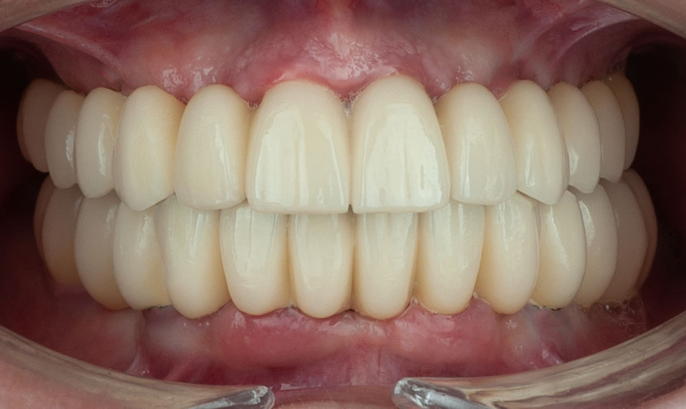 casos-odontologia-veronica-dental-corbella antes y despues (2)