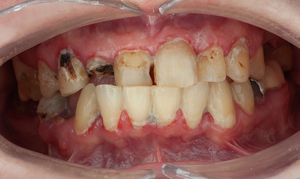 Banner-teresa-implantologia-avanzada-dental-corbella-3