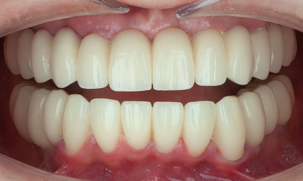 Banner-teresa-advanced-implantology-dental-corbella-4