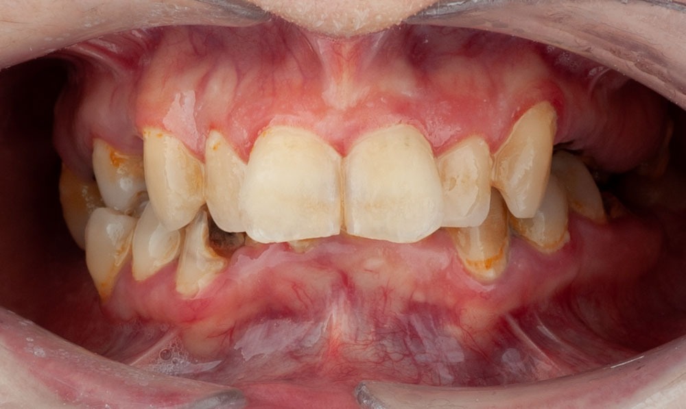 implatologia avanzada paciente nerea clinica dental corbella-4