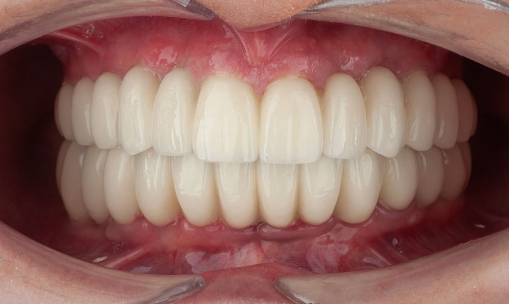 implatologia avanzada paciente nerea clinica dental corbella-5