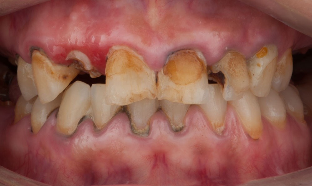patient adriana dental implants dental clinic corbella-1