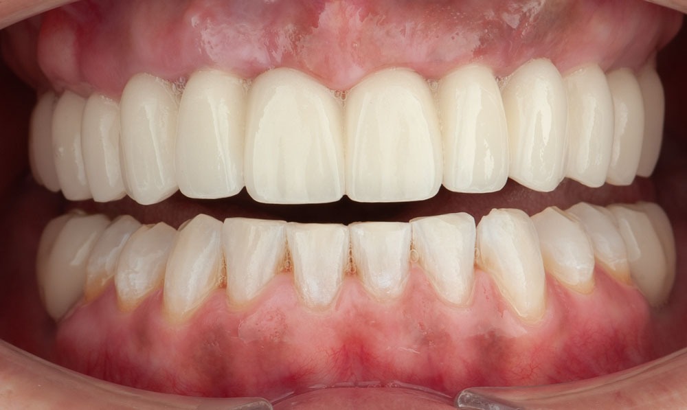 paciente adriana implantes dentales clinica dental corbella