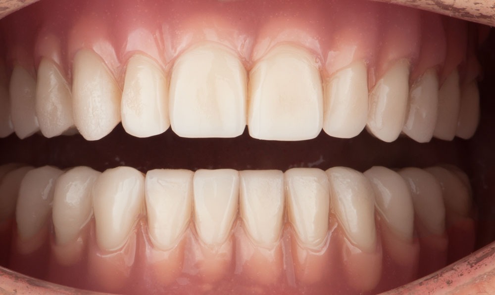 paciente amelia implantes dentales clinica dental corbella