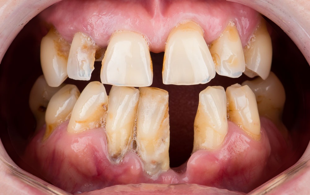 paciente ana implantes cigomaticos clinica dental corbella-1