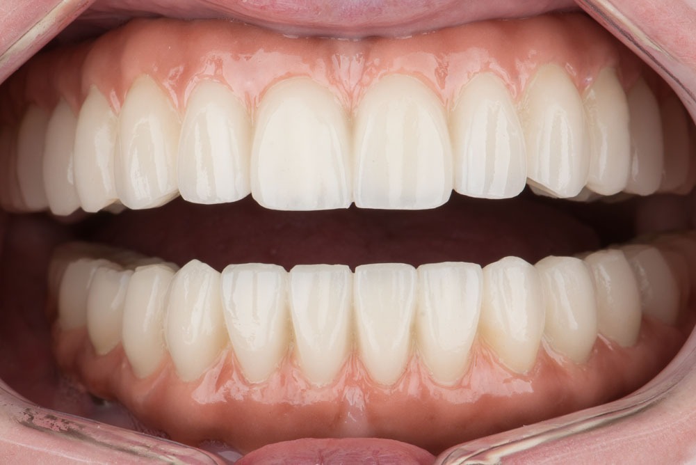 paciente ana implantes cigomaticos clinica dental corbella