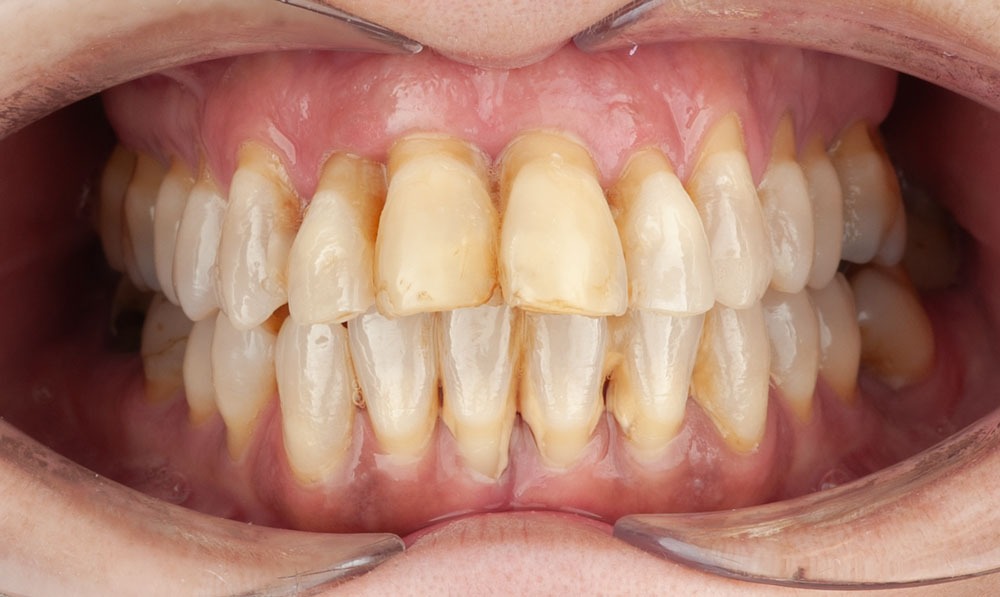 paciente ana implantes dental clinica dental corbella-2