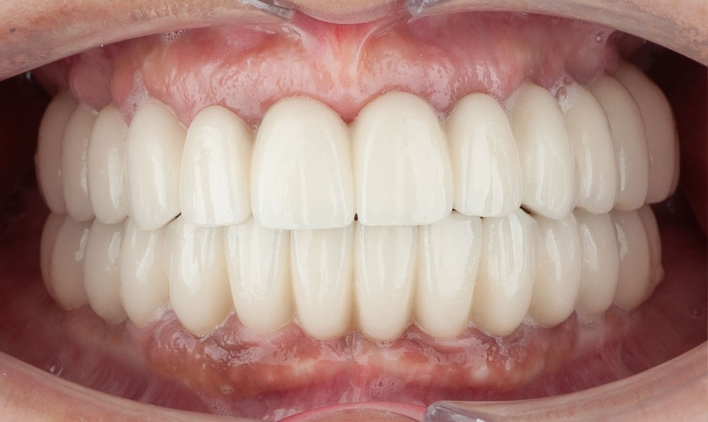 paciente ana implantes dental clinica dental corbella-3