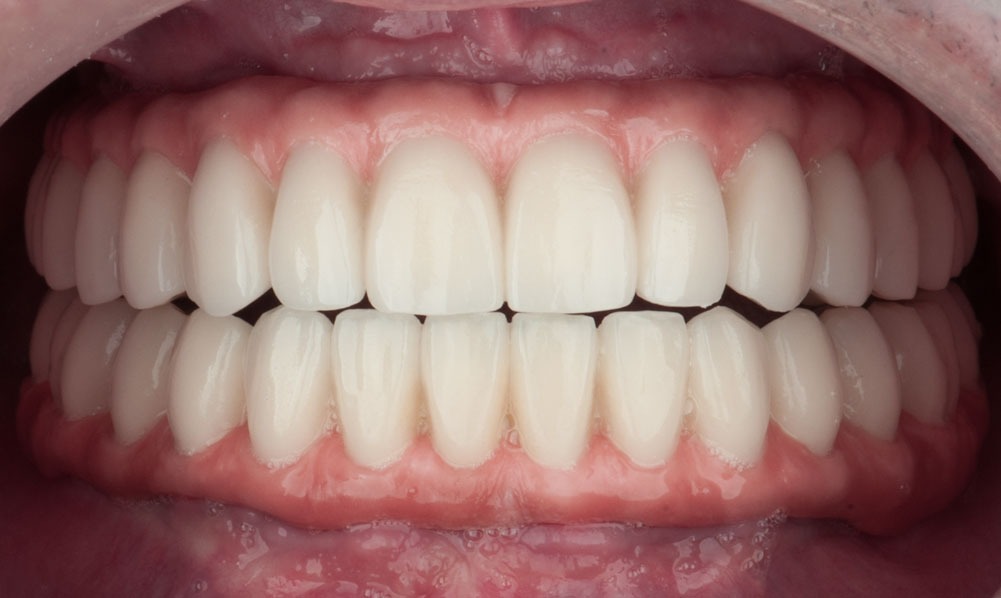 paciente anastasio implantes dentales clinica dental corbella-1