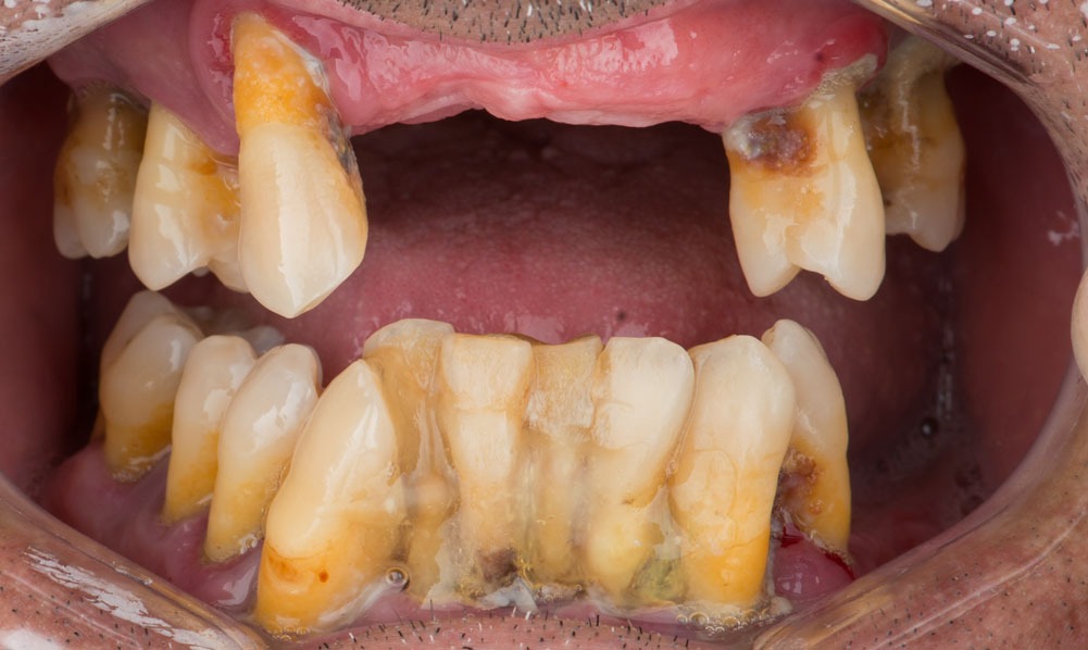 paciente anastasio implantes dentales clinica dental corbella-2