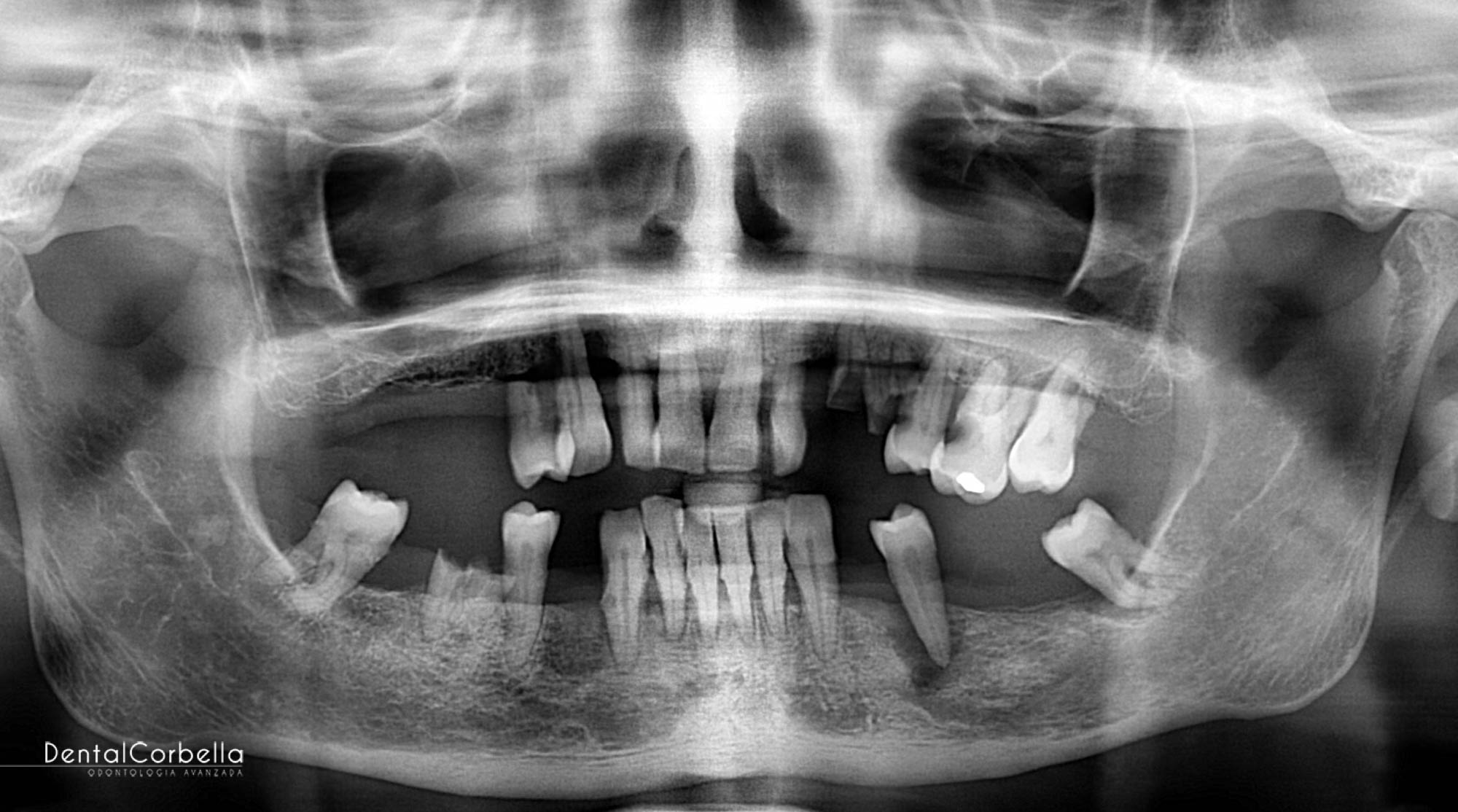 paciente belen implantes cigomaticos clinica dental corbella-3