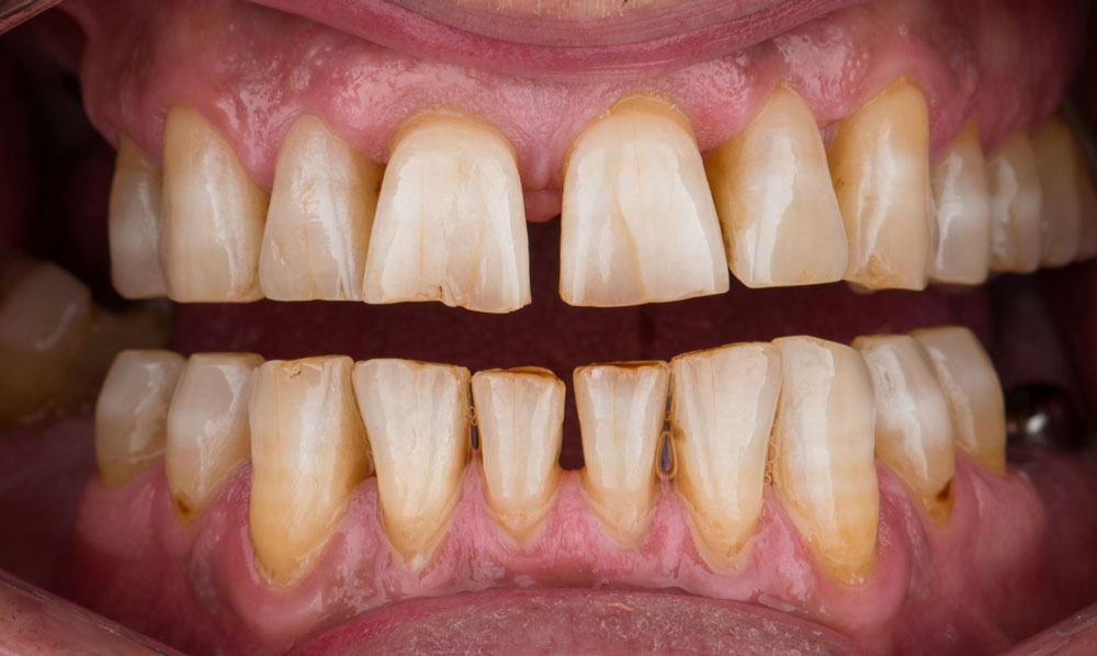 paciente david estetica dental clinica dental corbella-1