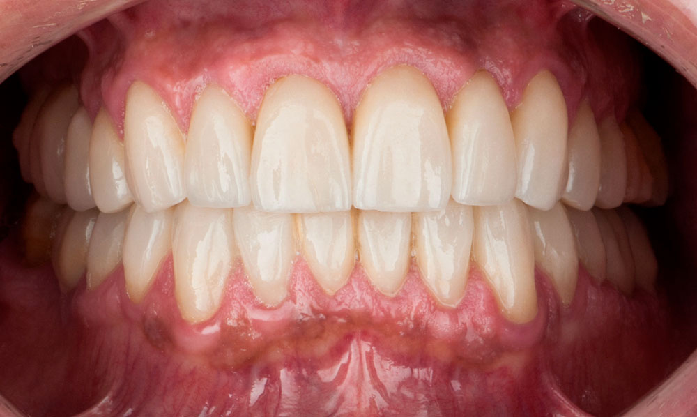 paciente david estetica dental clinica dental corbella