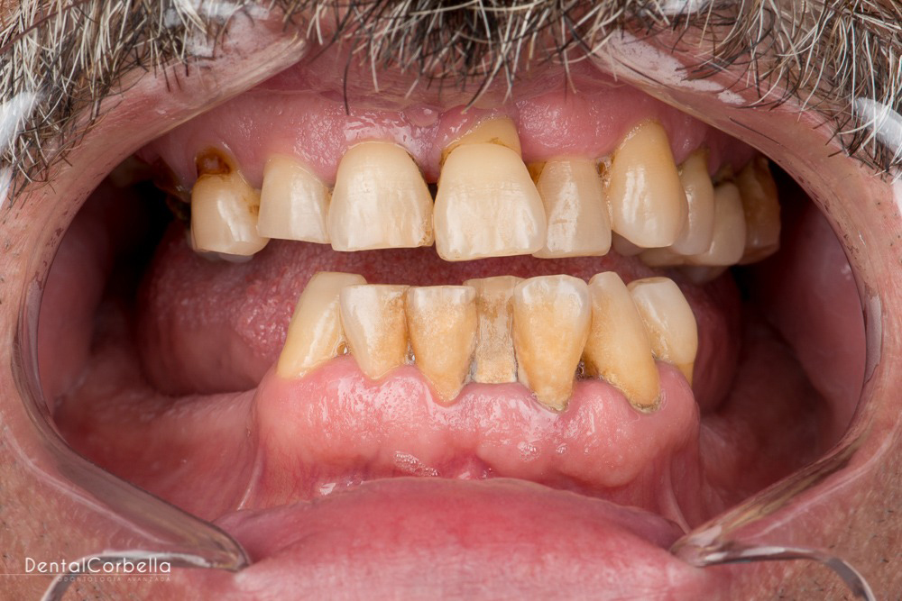 paciente eugenio implantes dentales clinica dental corbella-1