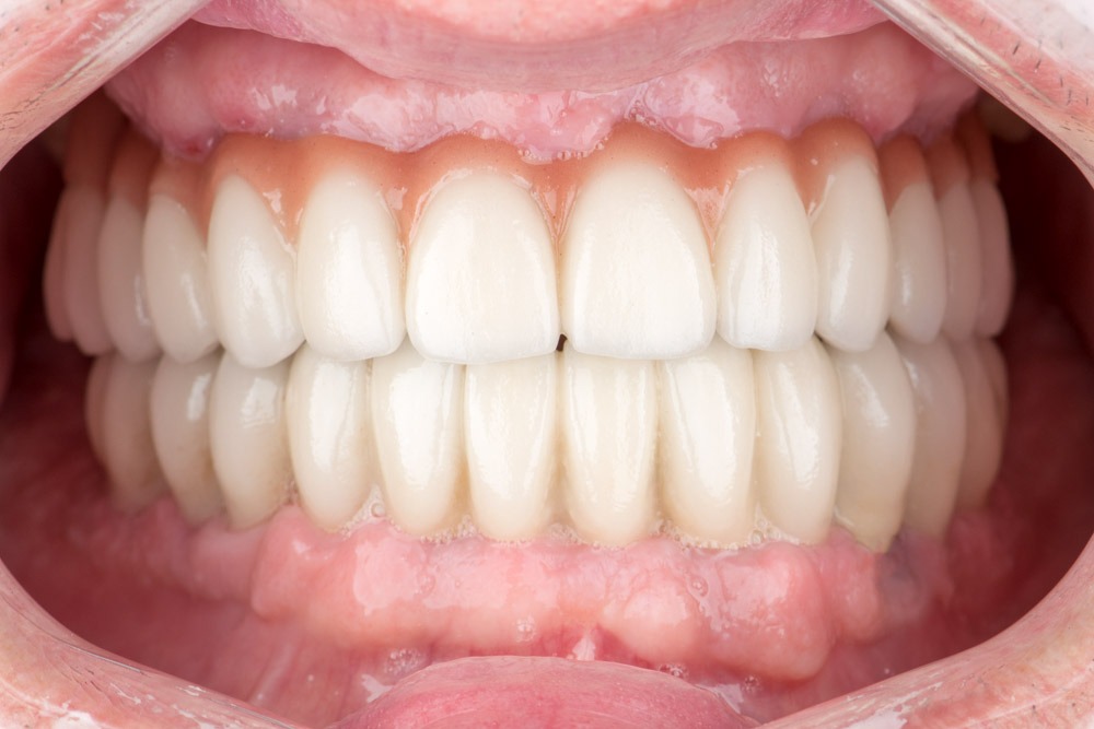 paciente eugenio implantes dentales clinica dental corbella-2