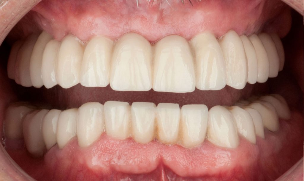 paciente fernando implantes dentales clinica dental corbella2