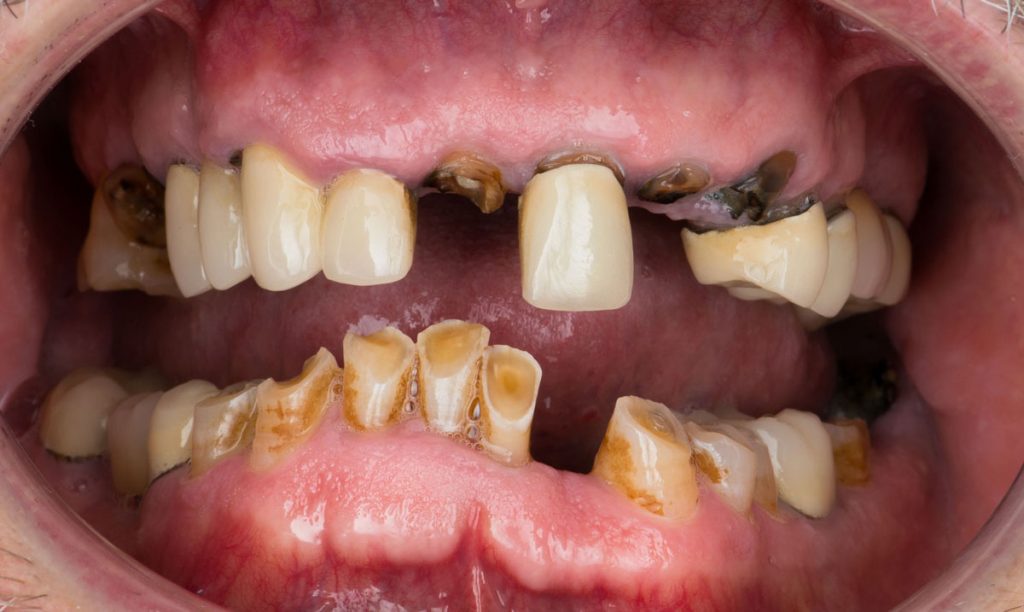 paciente fernando implantes dentales clinica dental corbella3
