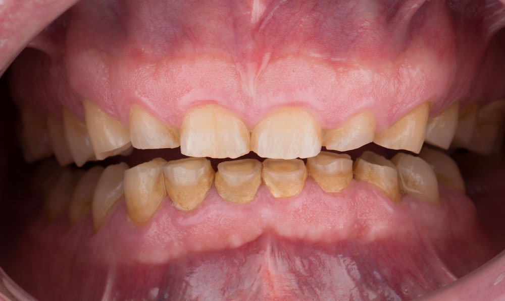 paciente francisco estetica dental clinica dental corbella-1