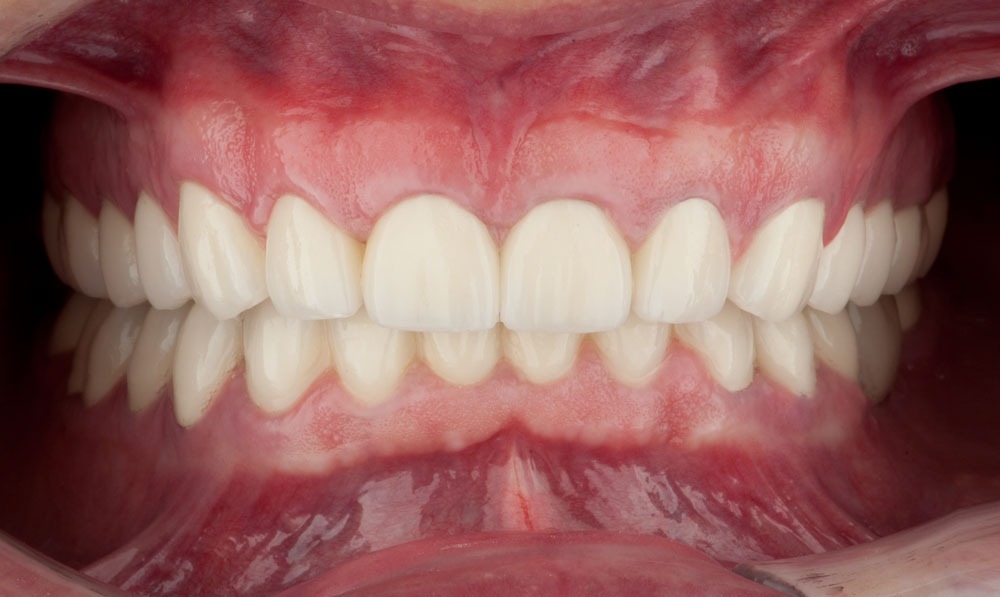 paciente francisco estetica dental clinica dental corbella