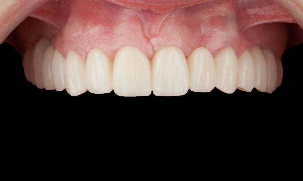 paciente isabel implantes dentales clinica dental corbella-1