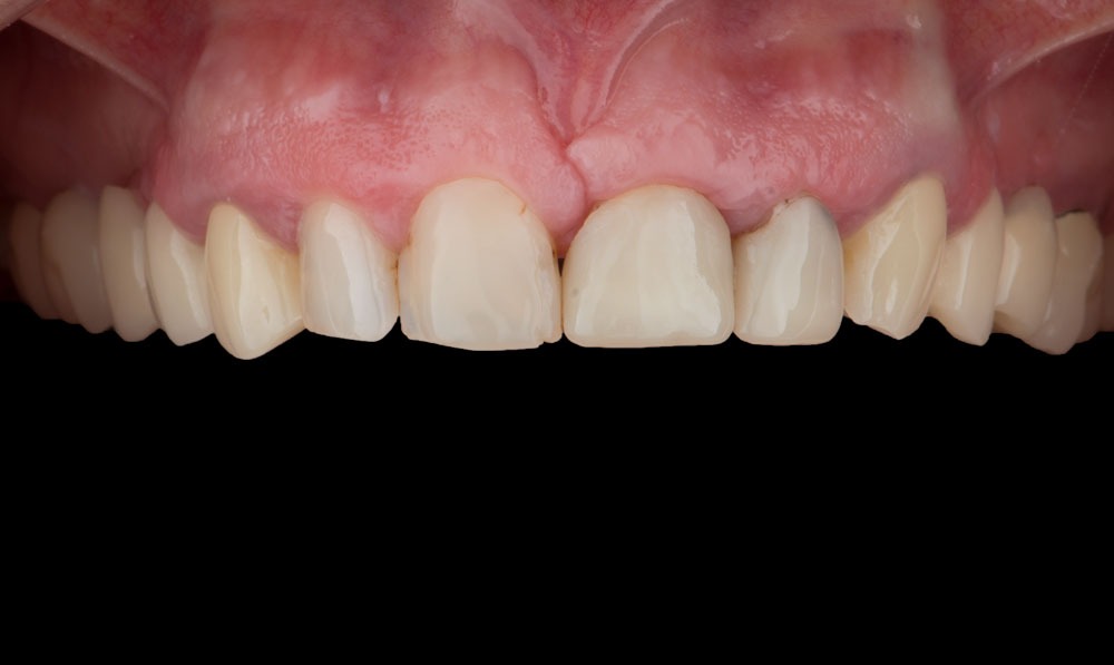 paciente isabel implantes dentales clinica dental corbella
