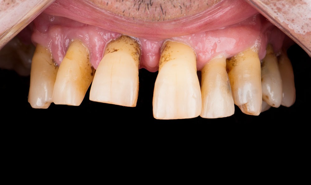 paciente james implantes dentales clinica dental corbella-1
