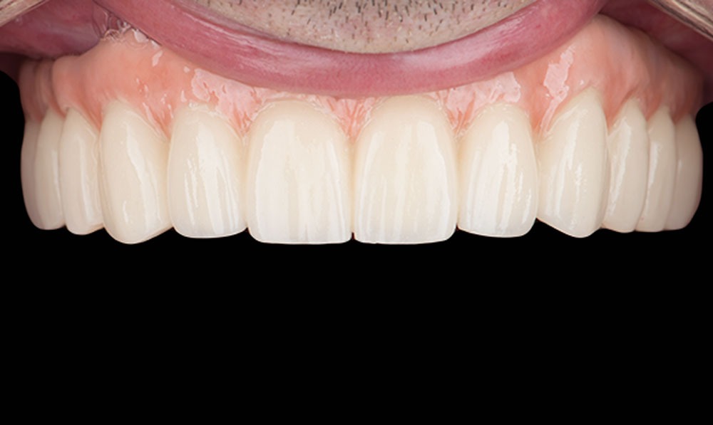paciente james implantes dentales clinica dental corbella