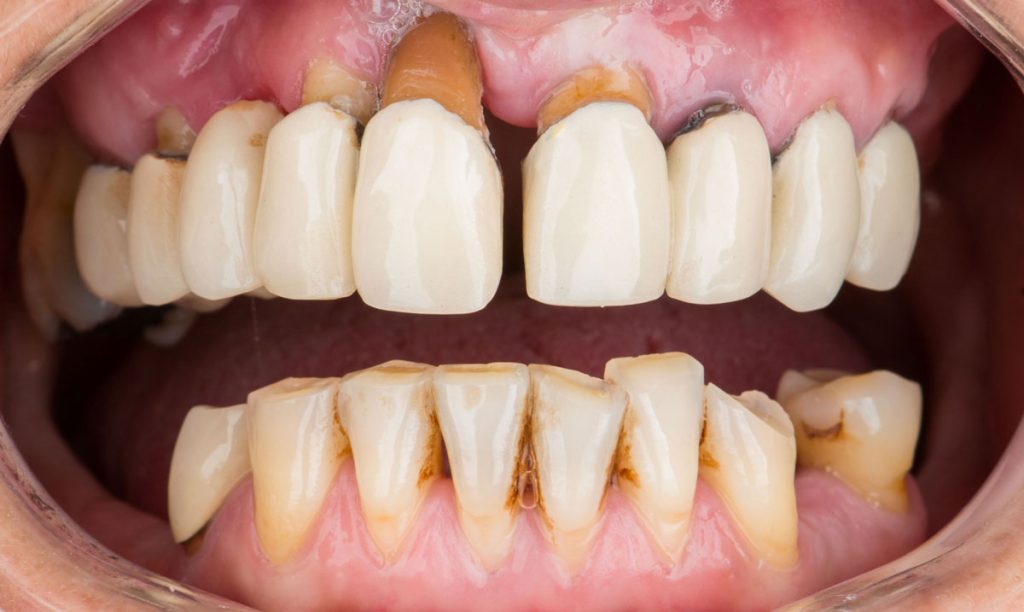 paciente jessica implantes dentales clinica dental corbella-1