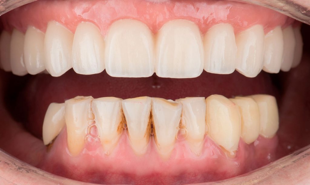 paciente jessica implantes dentales clinica dental corbella