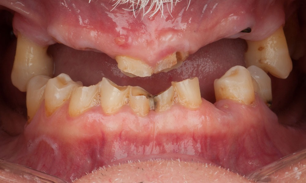 paciente juan implantes dentales clinica dental corbella madrid-1