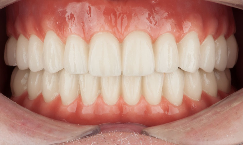 paciente juan implantes dentales clinica dental corbella madrid