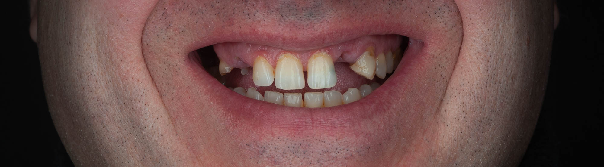 paciente juanjo implantologia clinica dental corbella