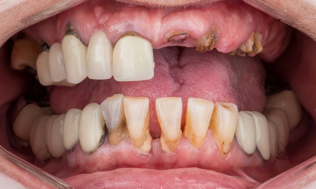 paciente julia implantes dentales clinica dental corbella-1