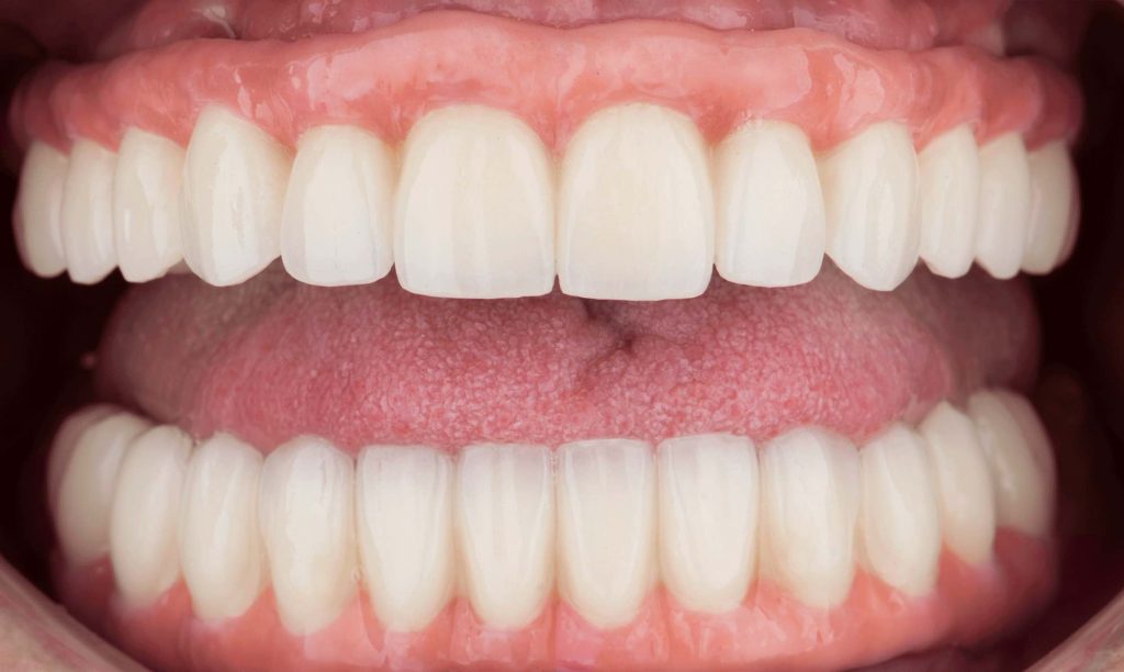 paciente julia implantes dentales clinica dental corbella