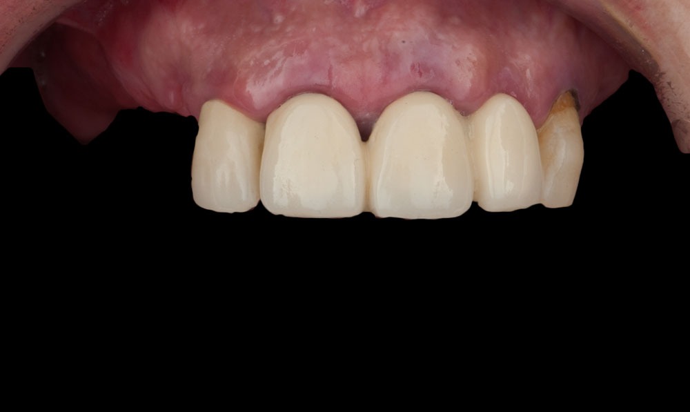 paciente leyre implantes dentales clinica dental corbella-1