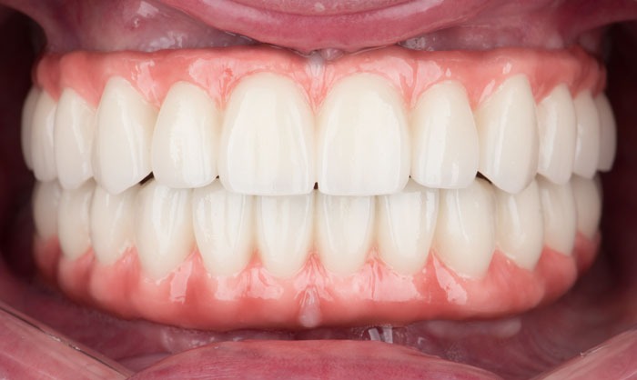 paciente lisa implantes dentales clinica dental corbella-1