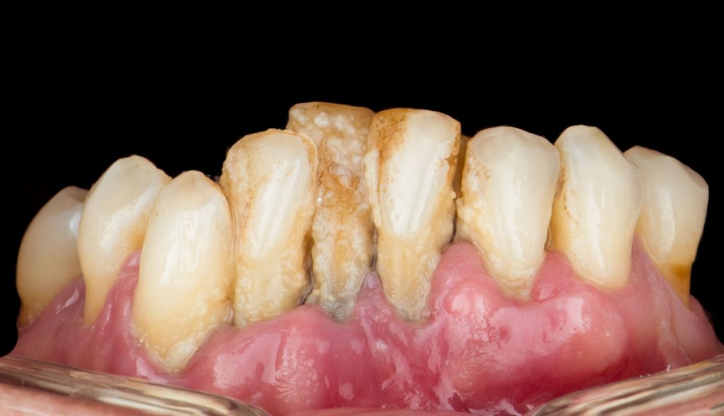 paciente marisa implantes dentales clinica dental corbella-1