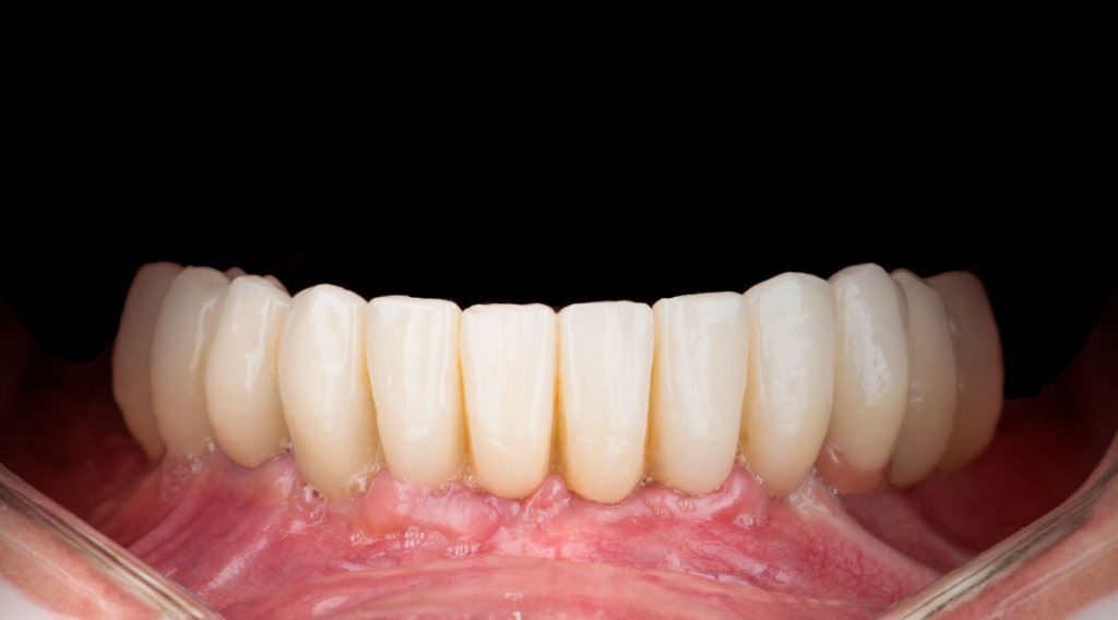 paciente marisa implantes dentales clinica dental corbella