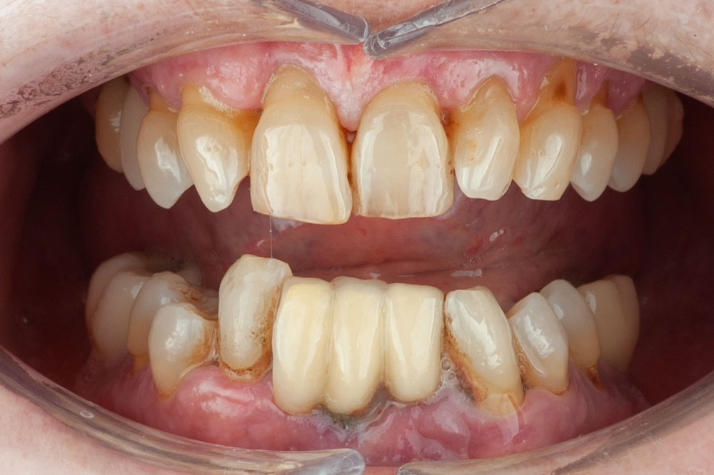 paciente nieves implantes dentales clinica dental corbella-3