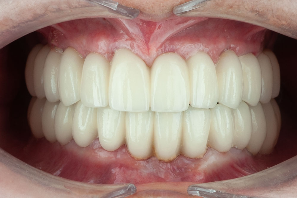 patient snows dental implants dental clinic corbella-4