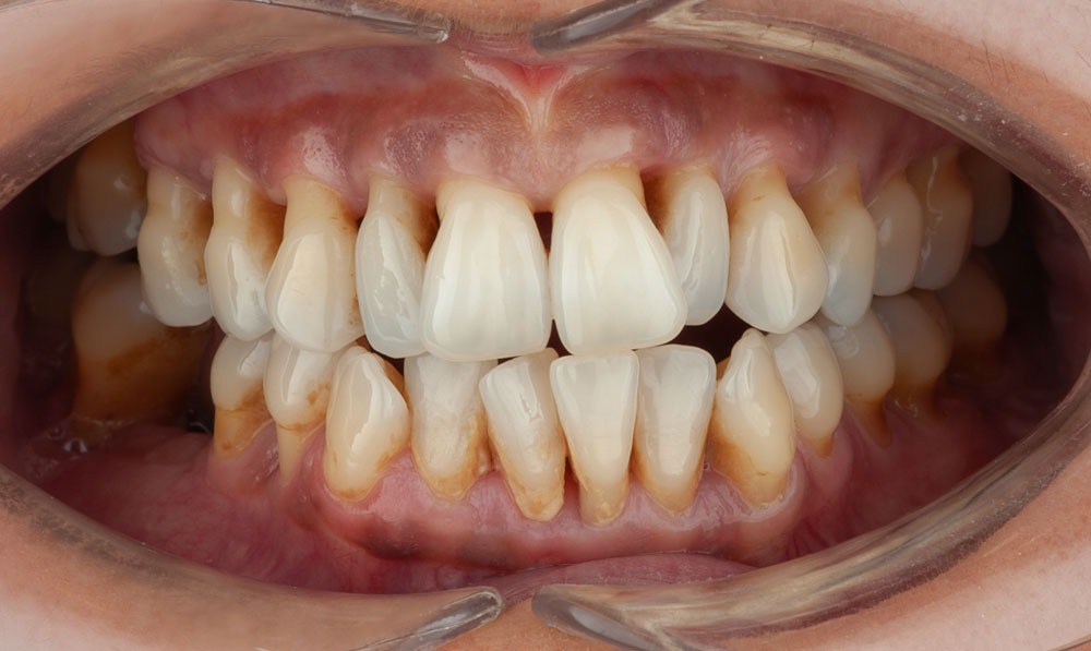 paciente noelia implantes dentales clinica dental corbella-2