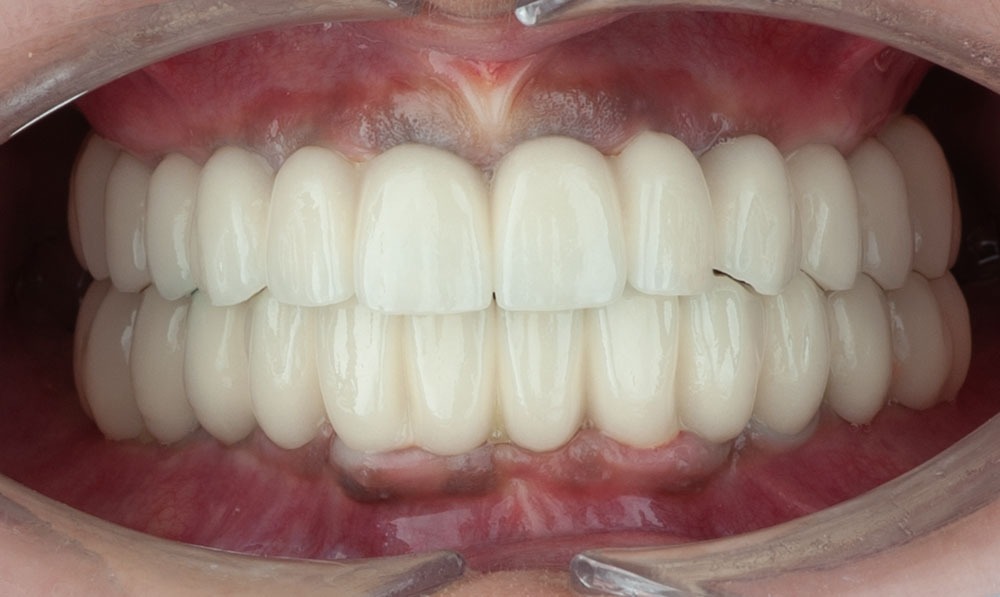paciente noelia implantes dentales clinica dental corbella-3