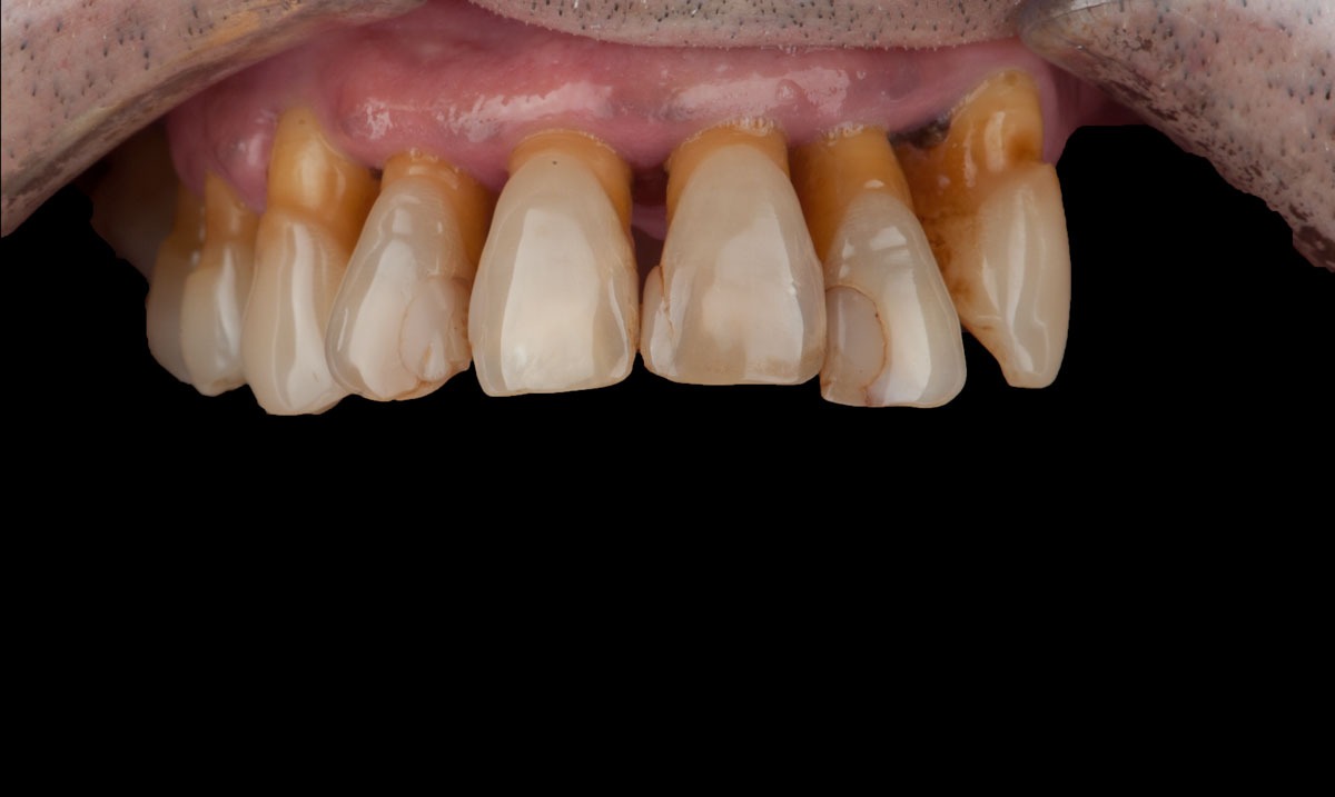 paciente paco implantes dentales clinica dental corbella-1