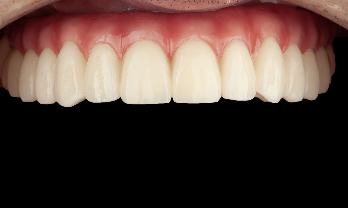paciente paco implantes dentales clinica dental corbella